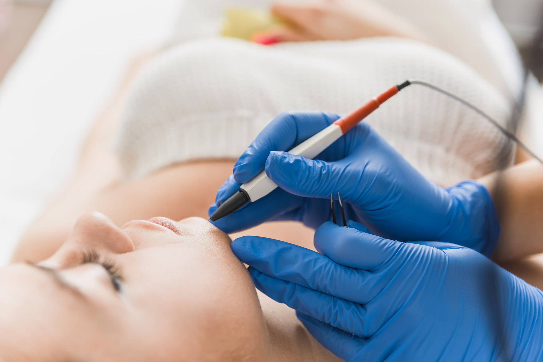 Electrolysis Laser Hair Removal